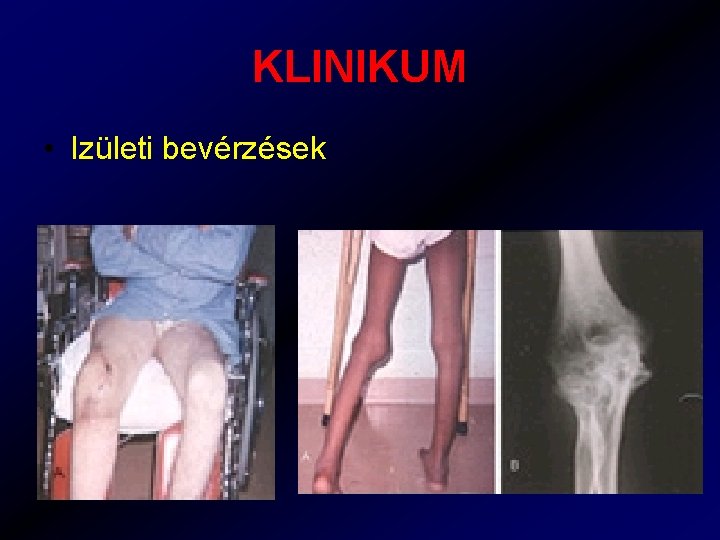 KLINIKUM • Izületi bevérzések 