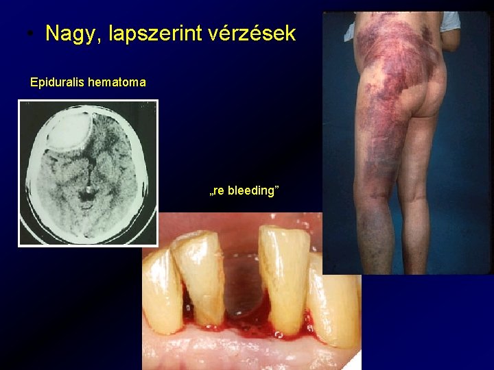  • Nagy, lapszerint vérzések Epiduralis hematoma „re bleeding” 