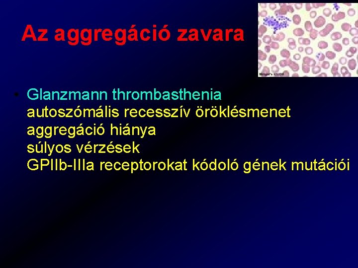 Az aggregáció zavara • Glanzmann thrombasthenia autoszómális recesszív öröklésmenet aggregáció hiánya súlyos vérzések GPIIb-IIIa