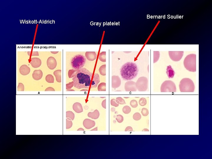 Wiskott-Aldrich Bernard Soulier Gray platelet 