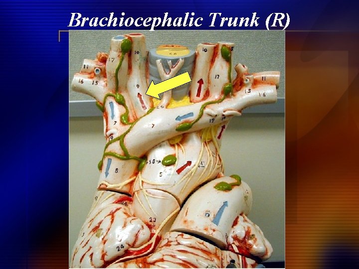 Brachiocephalic Trunk (R) 