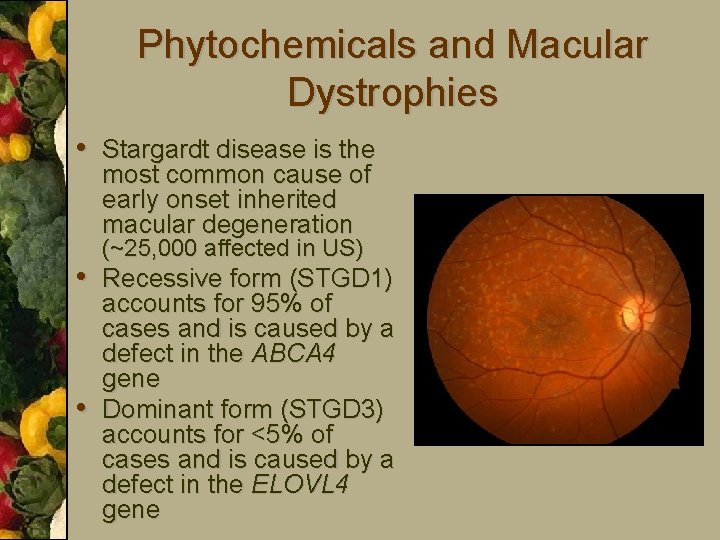 Phytochemicals and Macular Dystrophies • Stargardt disease is the most common cause of early