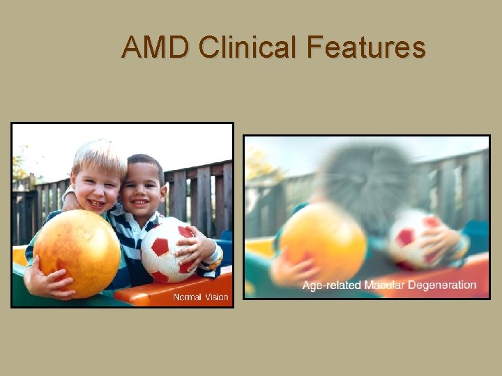 AMD Clinical Features 