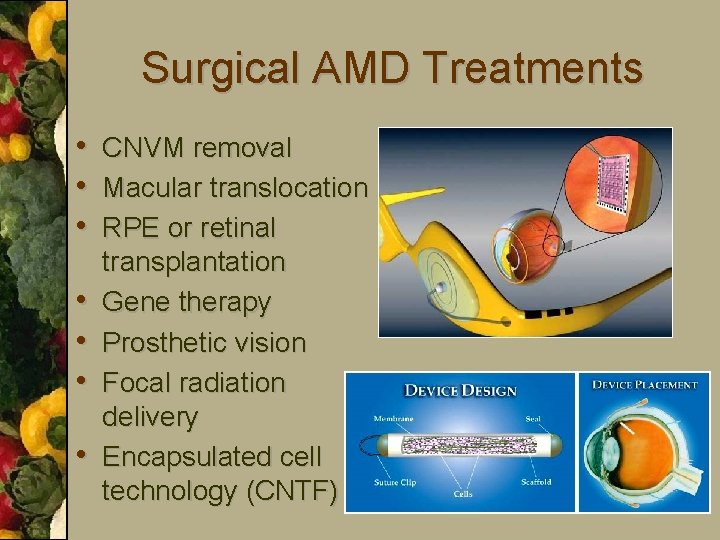 Surgical AMD Treatments • CNVM removal • Macular translocation • RPE or retinal •