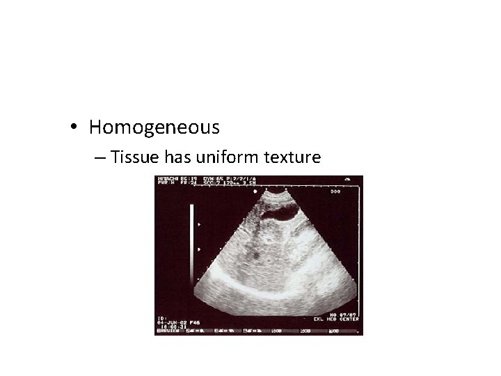  • Homogeneous – Tissue has uniform texture 