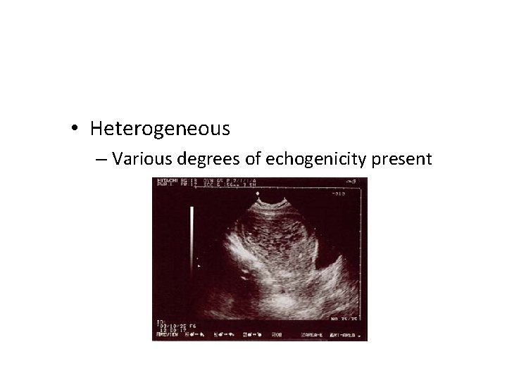  • Heterogeneous – Various degrees of echogenicity present 