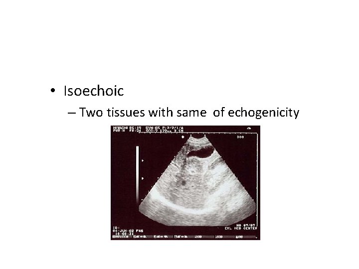  • Isoechoic – Two tissues with same of echogenicity 