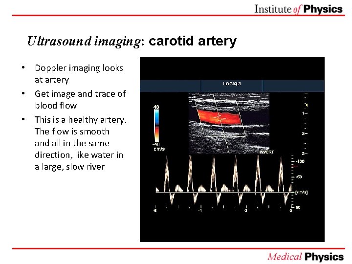 Ultrasound imaging: carotid artery • Doppler imaging looks at artery • Get image and