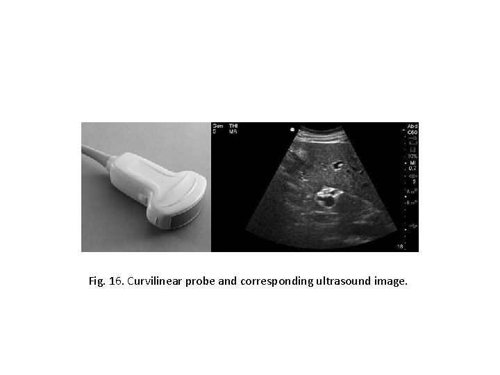 Fig. 16. Curvilinear probe and corresponding ultrasound image. 