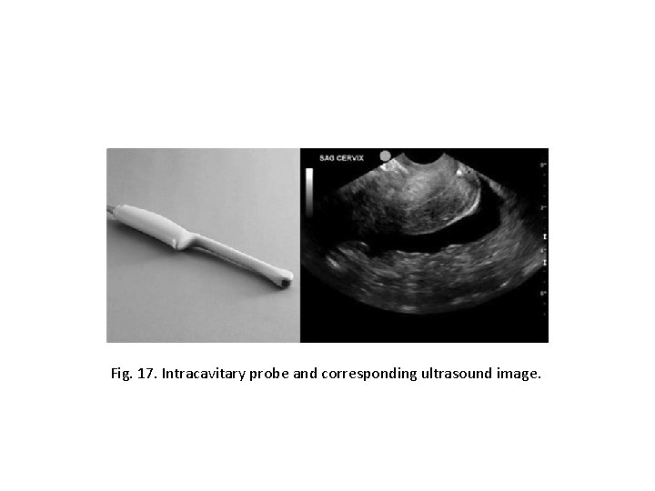Fig. 17. Intracavitary probe and corresponding ultrasound image. 