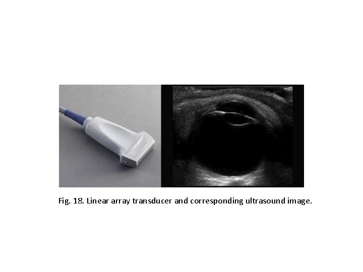 Fig. 18. Linear array transducer and corresponding ultrasound image. 