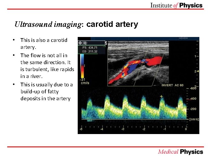 Ultrasound imaging: carotid artery • This is also a carotid artery. • The flow