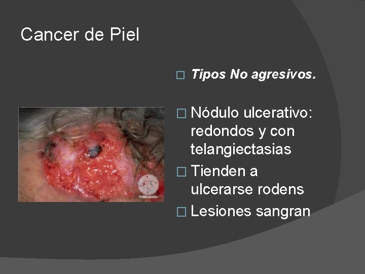 Cancer de Piel � Tipos No agresivos. � Nódulo ulcerativo: redondos y con telangiectasias