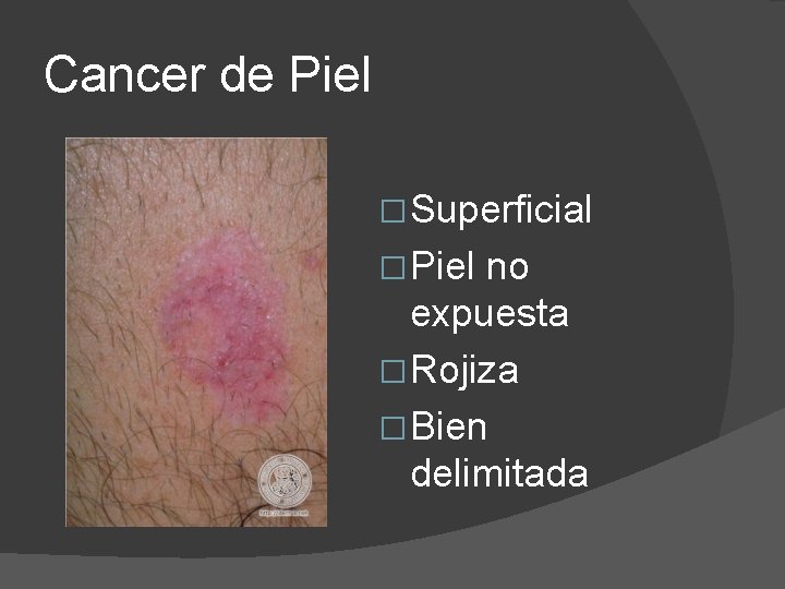 Cancer de Piel � Superficial � Piel no expuesta � Rojiza � Bien delimitada