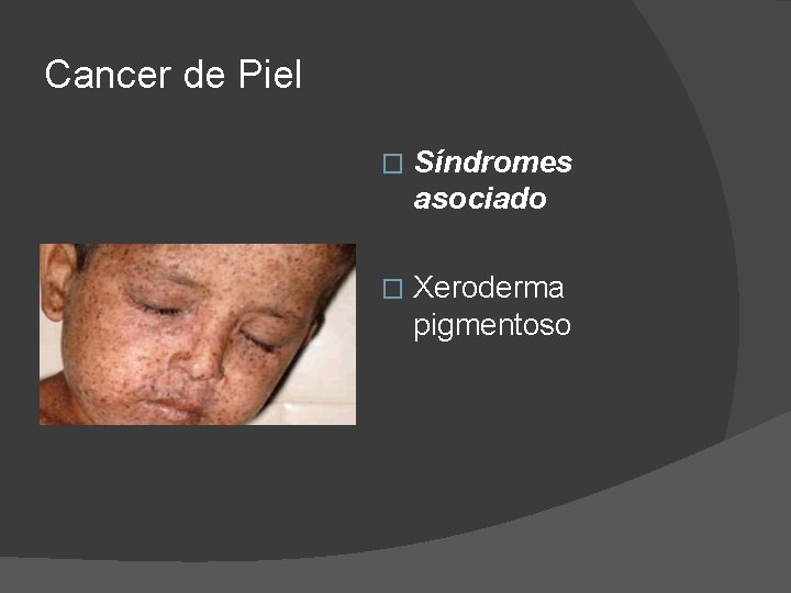 Cancer de Piel � Síndromes asociado � Xeroderma pigmentoso 