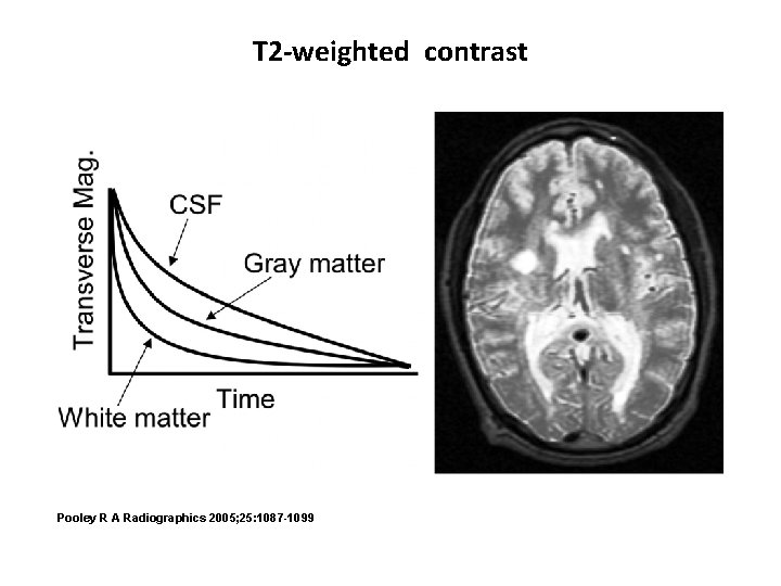 T 2 -weighted contrast Pooley R A Radiographics 2005; 25: 1087 -1099 