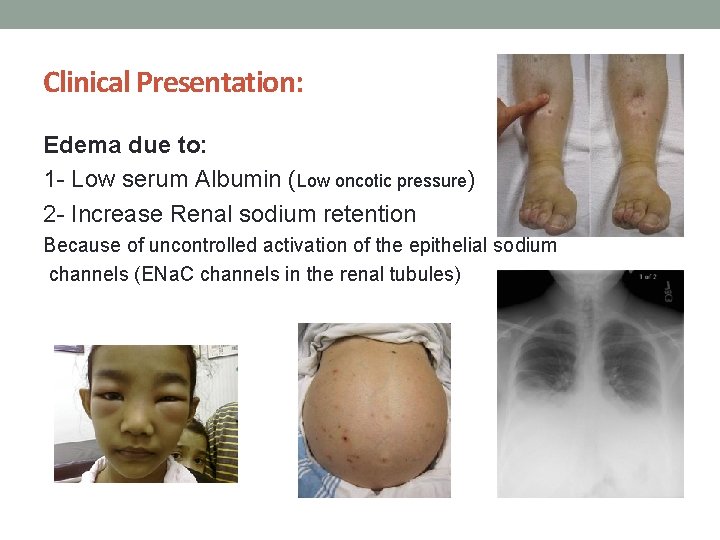 Clinical Presentation: Edema due to: 1 - Low serum Albumin (Low oncotic pressure) 2