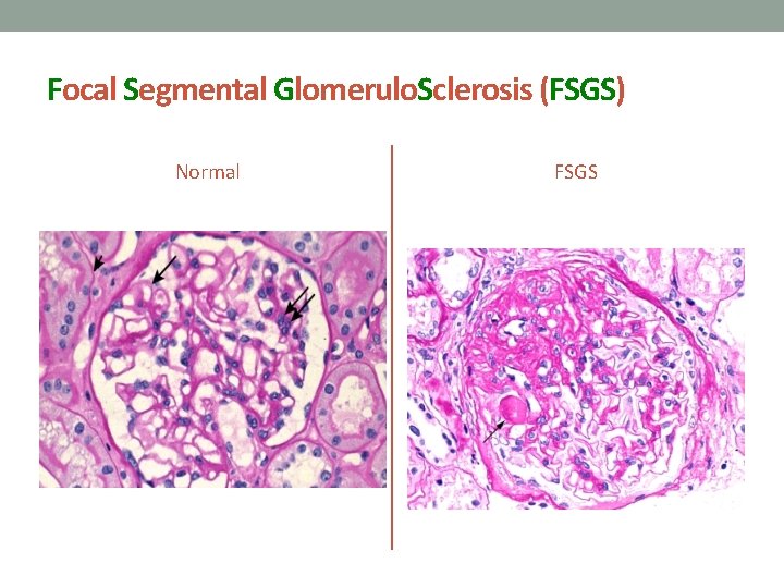Focal Segmental Glomerulo. Sclerosis (FSGS) Normal FSGS 