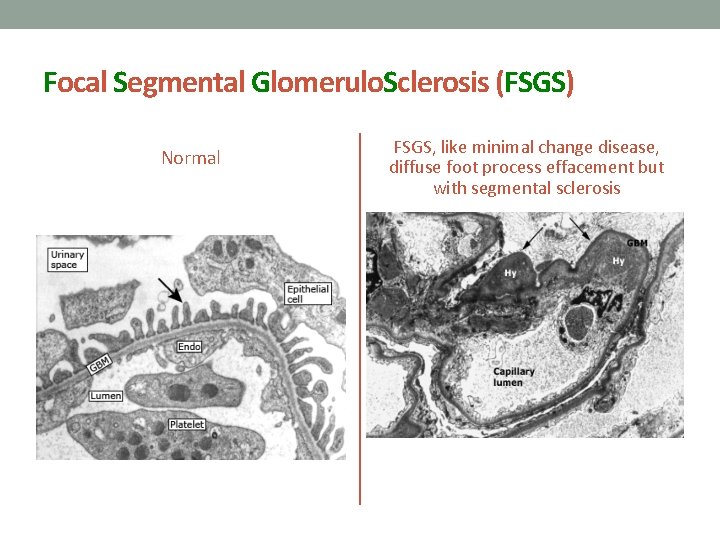 Focal Segmental Glomerulo. Sclerosis (FSGS) Normal FSGS, like minimal change disease, diffuse foot process