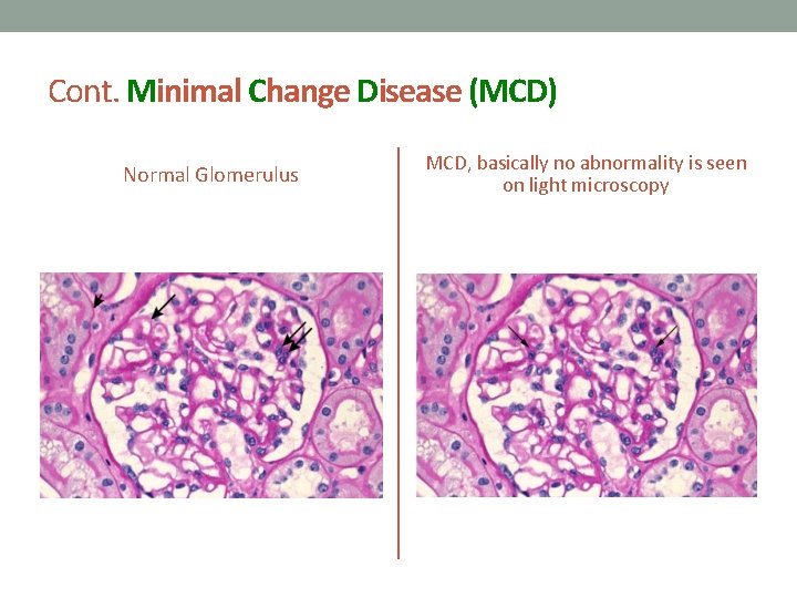 Cont. Minimal Change Disease (MCD) Normal Glomerulus MCD, basically no abnormality is seen on