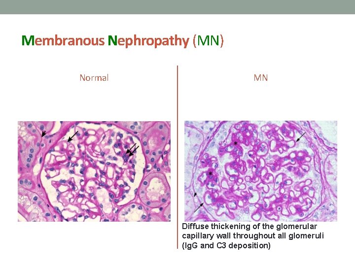 Membranous Nephropathy (MN) Normal MN Diffuse thickening of the glomerular capillary wall throughout all