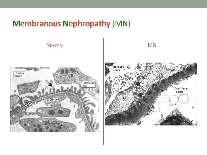Membranous Nephropathy (MN) Normal MN 