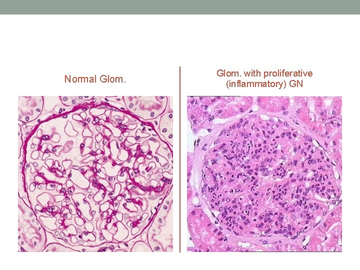 Normal Glom. with proliferative (inflammatory) GN 