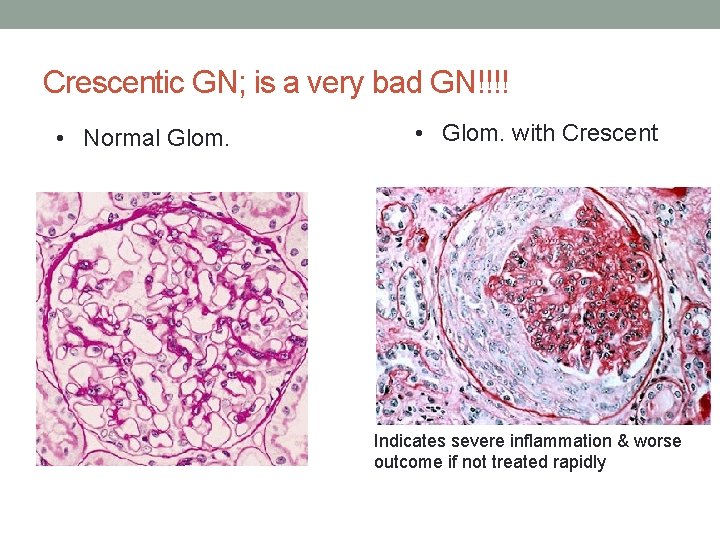 Crescentic GN; is a very bad GN!!!! • Normal Glom. • Glom. with Crescent