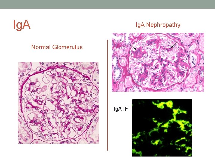 Ig. A Nephropathy Normal Glomerulus Ig. A IF 