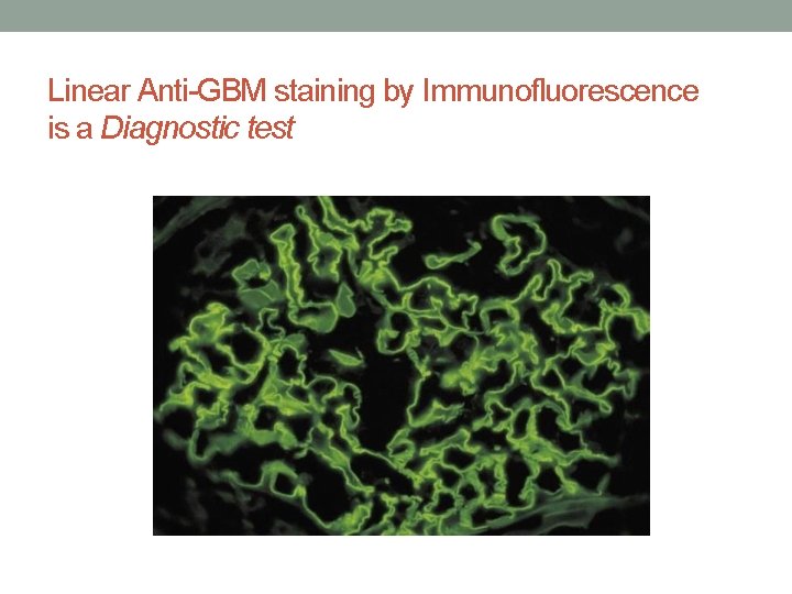 Linear Anti-GBM staining by Immunofluorescence is a Diagnostic test 