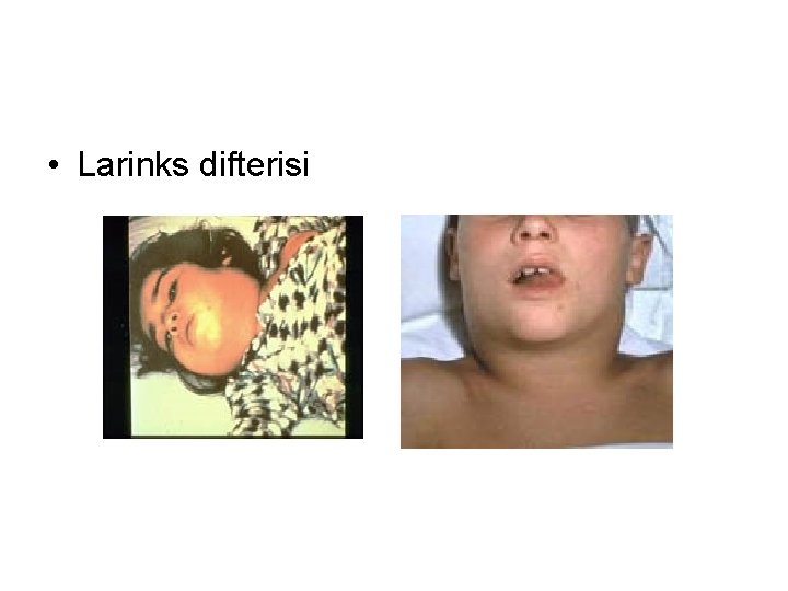  • Larinks difterisi 