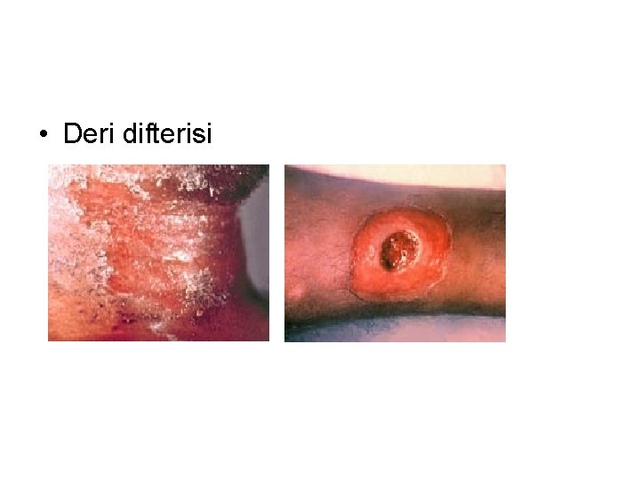  • Deri difterisi 