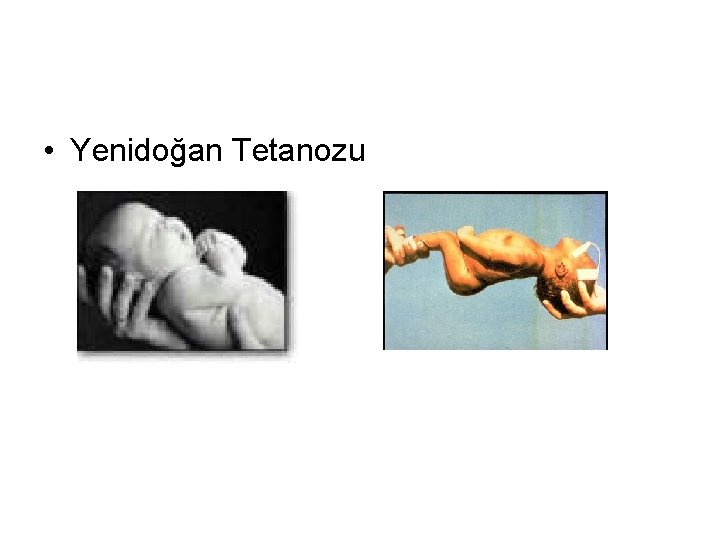  • Yenidoğan Tetanozu 