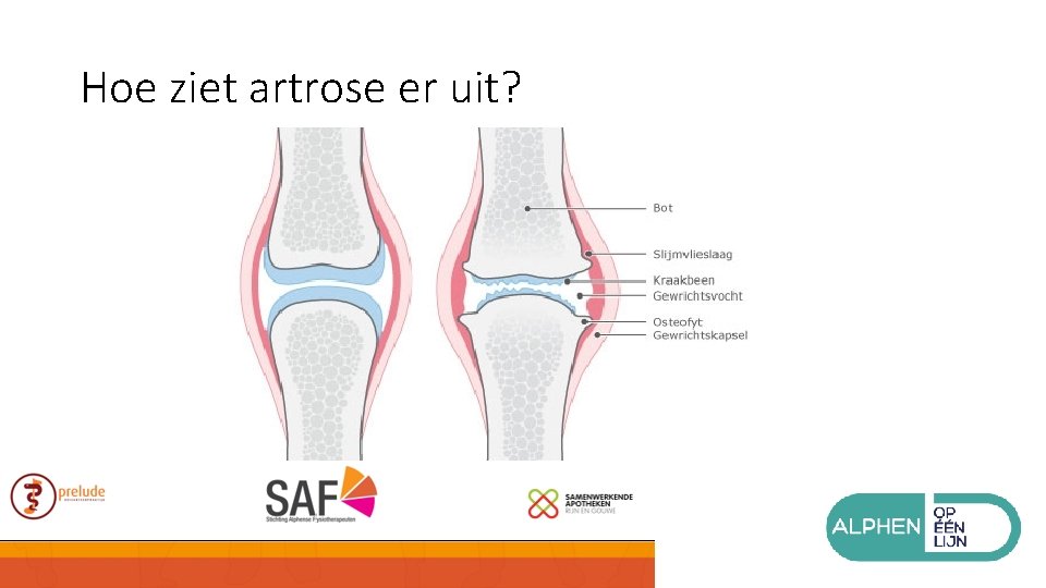 Hoe ziet artrose er uit? 