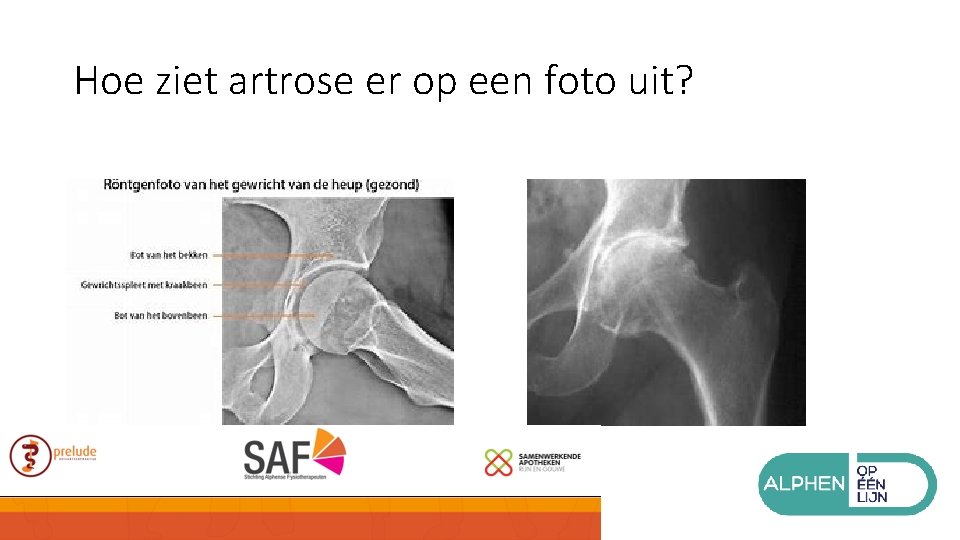 Hoe ziet artrose er op een foto uit? 