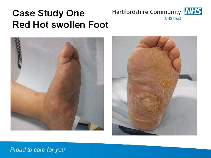 Case Study One Red Hot swollen Foot 