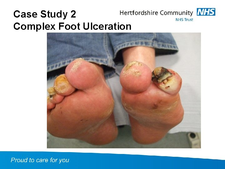 Case Study 2 Complex Foot Ulceration 