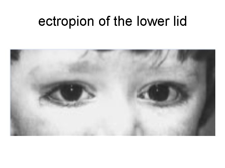 ectropion of the lower lid 