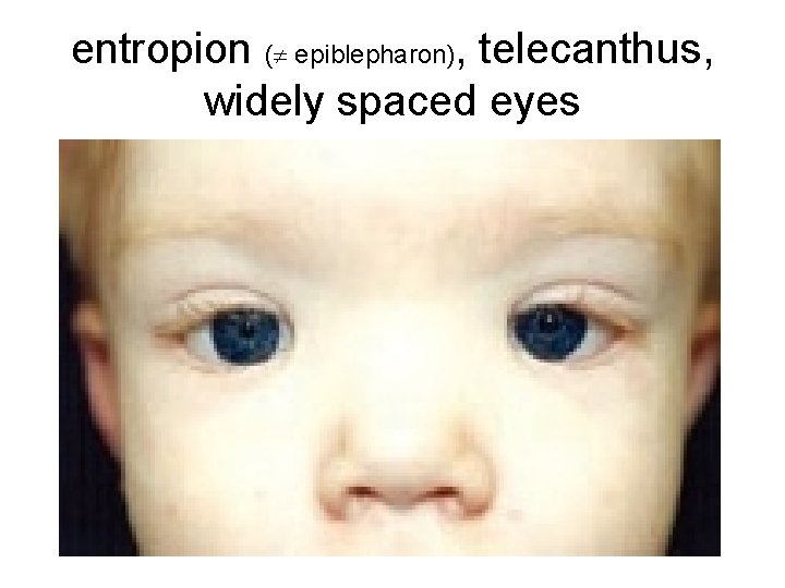 entropion ( epiblepharon), telecanthus, widely spaced eyes 