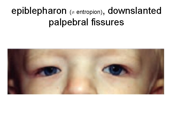 epiblepharon ( entropion), downslanted palpebral fissures 