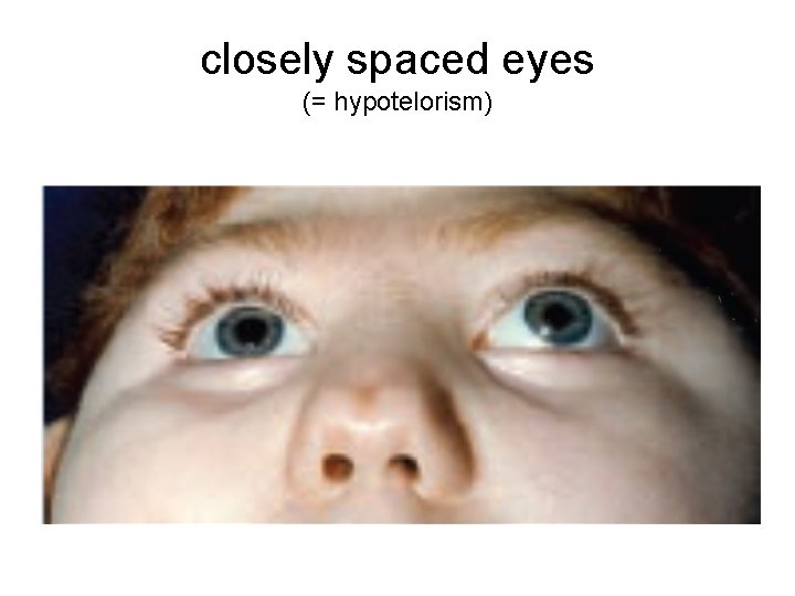 closely spaced eyes (= hypotelorism) 
