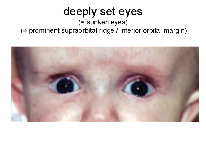 deeply set eyes (= sunken eyes) ( prominent supraorbital ridge / inferior orbital margin)