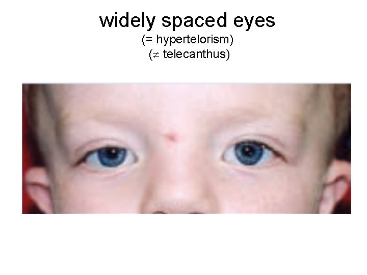 widely spaced eyes (= hypertelorism) ( telecanthus) 