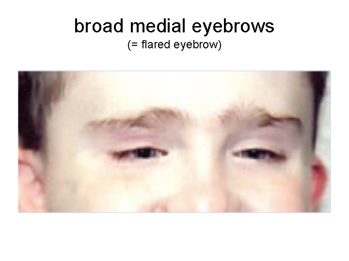 broad medial eyebrows (= flared eyebrow) 