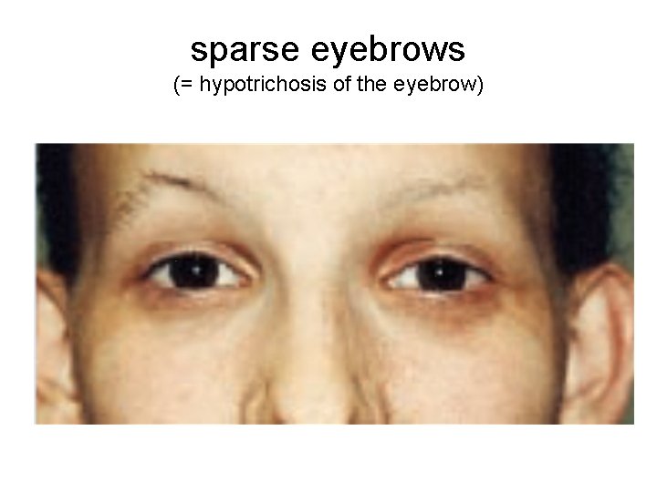 sparse eyebrows (= hypotrichosis of the eyebrow) 