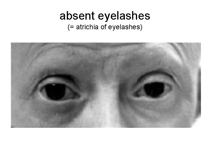 absent eyelashes (= atrichia of eyelashes) 