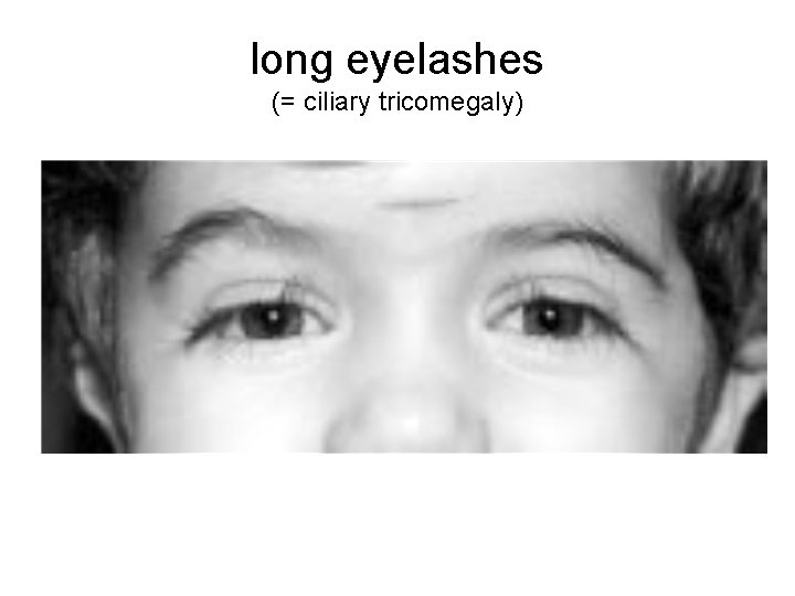 long eyelashes (= ciliary tricomegaly) 