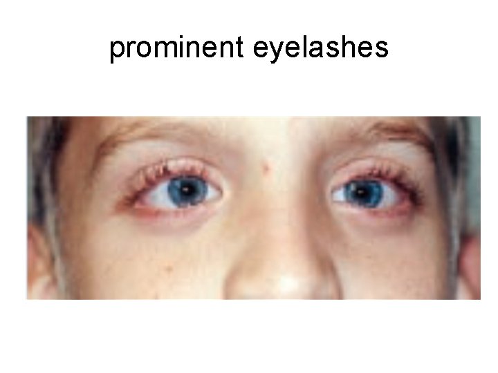 prominent eyelashes 