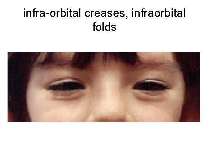 infra-orbital creases, infraorbital folds 