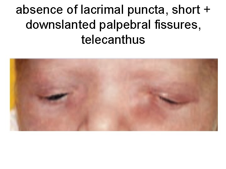 absence of lacrimal puncta, short + downslanted palpebral fissures, telecanthus 